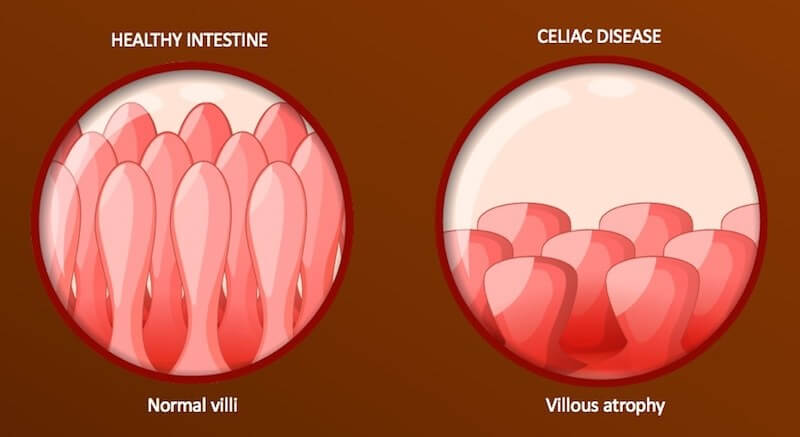 celiac disease treatment